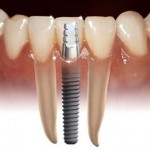 implant5