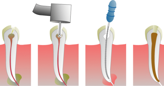 Kanal Tedavisi (Endodonti)